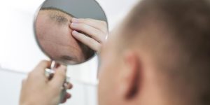 Alopecia y sus tratamientos